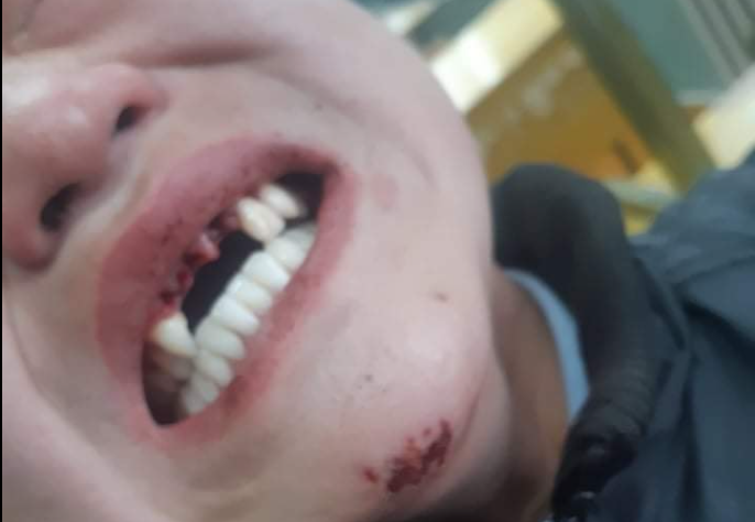 Сурагчид зодолдож, нэгнийхээ үүдэн шүдийг цөм цохижээ