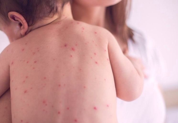 Нэг өдөрт буюу өчигдөр Улаанбурхан өвчний 25 тохиолдол бүртгэгджээ